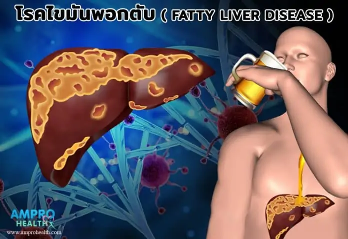 โรคไขมันพอกตับ ( Fatty liver disease )