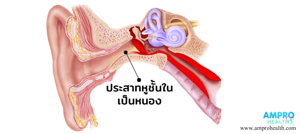 ไข้หูดับ หรือโรคติดเชื้อ สเตรฟโตคอกคัส ซูอิส ( Streptococcus suis )