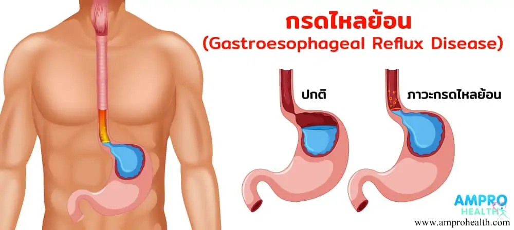 กรดไหลย้อน ( Gastroesophageal Reflux Disease : GERD )