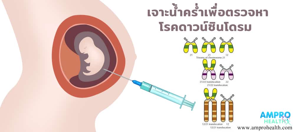 ดาวน์ซินโดรม ( Down Syndrome )