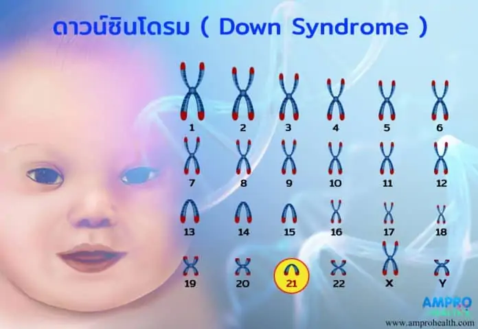 ดาวน์ซินโดรม ( Down Syndrome )