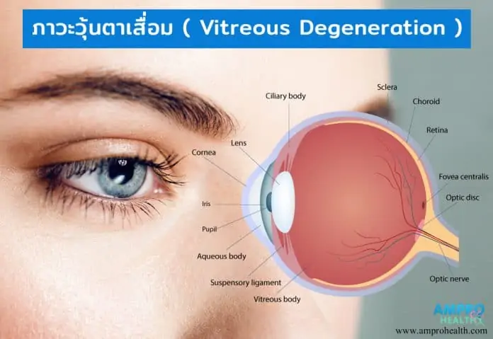 ภาวะวุ้นตาเสื่อม ( Vitreous Degeneration ) เป็นอย่างไร