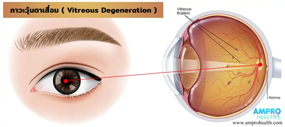 ภาวะวุ้นตาเสื่อม ( Vitreous Degeneration ) เป็นอย่างไร