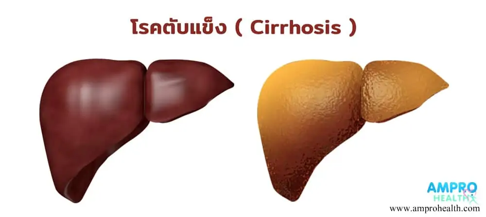 โรคตับแข็ง ( Cirrhosis ) เกิดได้อย่างไรกัน