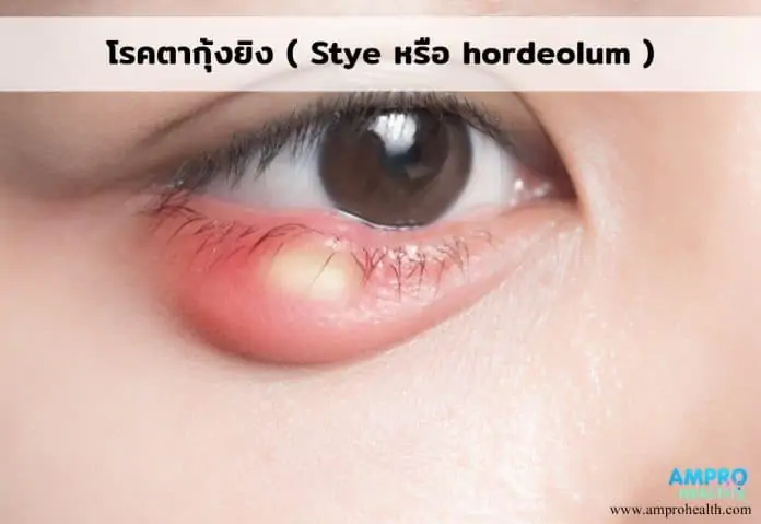 โรคตากุ้งยิง ( Stye หรือ hordeolum )