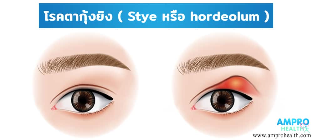 โรคตากุ้งยิง ( Stye หรือ hordeolum )