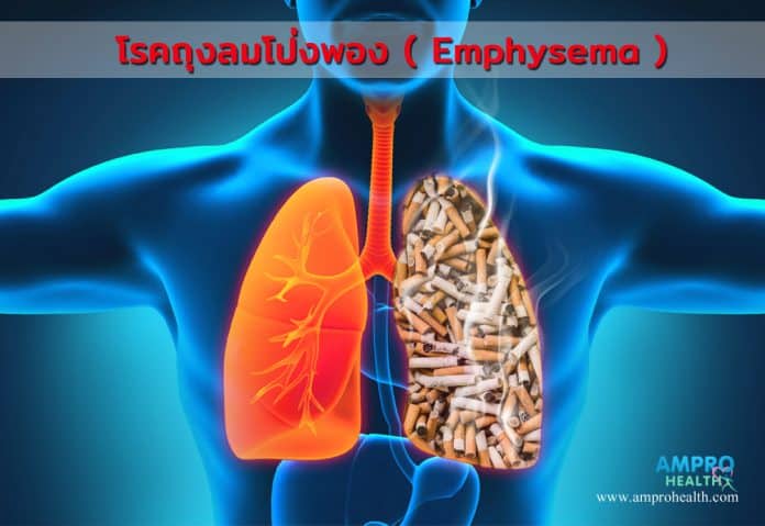 โรคถุงลมโป่งพอง ( Emphysema )