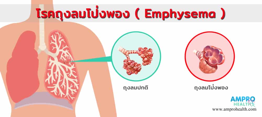 โรคถุงลมโป่งพอง ( Emphysema )