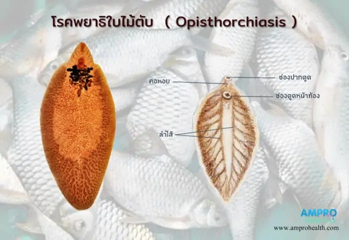 โรคพยาธิใบไม้ตับ ( Opisthorchiasis )