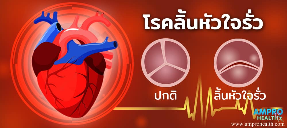 ลิ้นหัวใจรั่ว ( Heart Valve Regurgitation ) เป็นอย่างไร