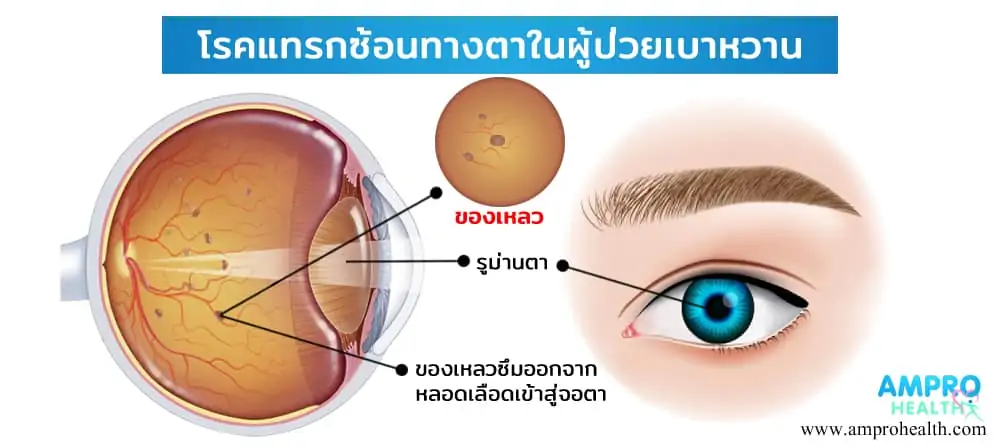 โรคแทรกซ้อนทางตาในผู้ป่วยเบาหวาน