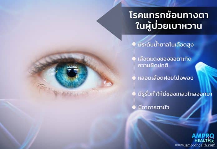 โรคแทรกซ้อนทางตาในผู้ป่วยเบาหวาน โรคแทรกซ้อนทางตาในผู้ป่วยเบาหวาน