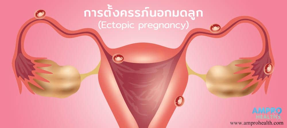 การตั้งครรภ์นอกมดลูก (Ectopic-pregnancy)