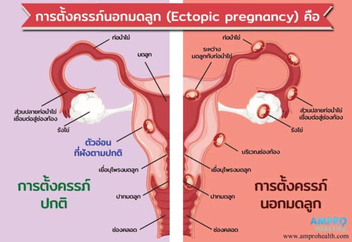 การตั้งครรภ์นอกมดลูก (Ectopic-pregnancy)