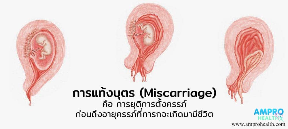 การแท้งบุตร หรือการแท้งลูก ( Miscarriage ) เกิดได้อย่างไร