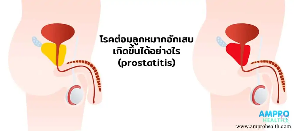 ต่อมลูกหมากอักเสบ ( Prostatitis ) เกิดขึ้นได้อย่างไร