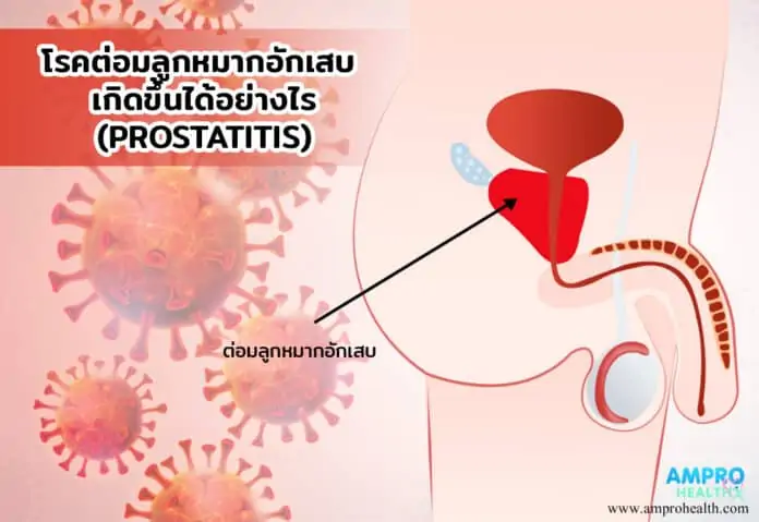 ต่อมลูกหมากอักเสบ ( Prostatitis ) เกิดขึ้นได้อย่างไร