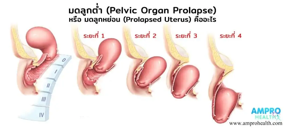 มดลูกต่ำ ( Pelvic Organ Prolapse ) หรือ มดลูกหย่อน ( Prolapsed Uterus ) มีอาการอย่างไร