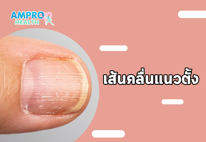 เส้นคลื่นแนวตั้ง 1 - เล็บเป็นคลื่นบ่งบอกอะไร ตรวจสอบสัญญาณสุขภาพที่แฝงอยู่ในเล็บ