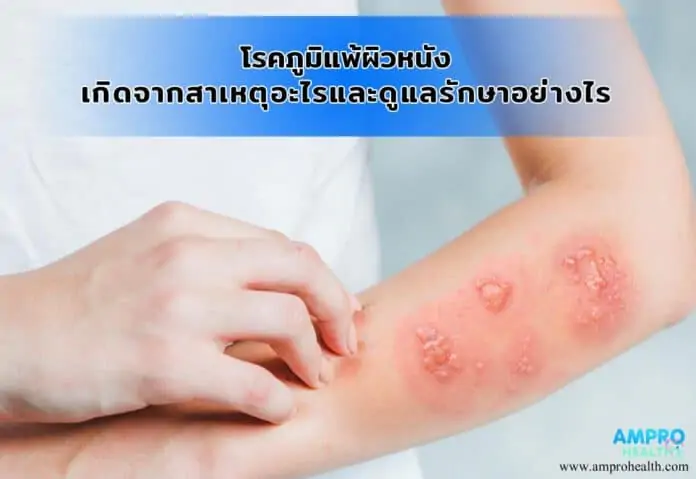 โรคภูมิแพ้ผิวหนัง เกิดจากสาเหตุอะไร และดูแลรักษาอย่างไร