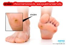 ตาปลา เกิดจากสาเหตุอะไร และดูแลรักษาอย่างไร ตาปลา เกิดจากสาเหตุอะไร และดูแลรักษาอย่างไร