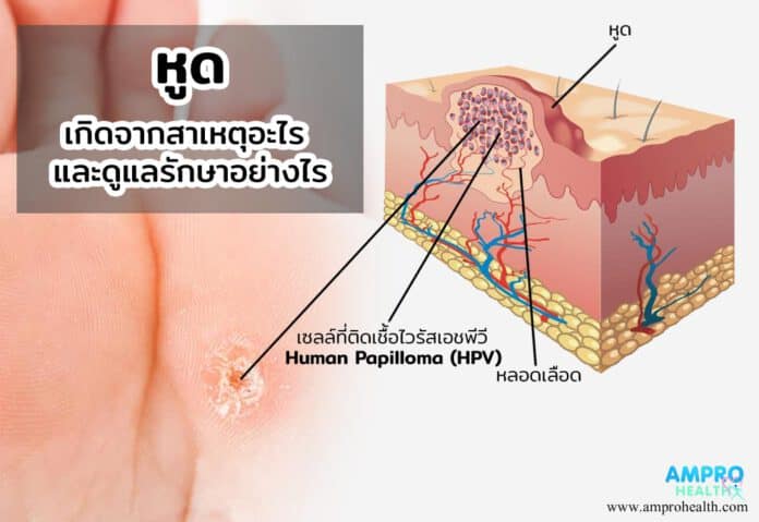 หูด เกิดจากสาเหตุอะไร และดูแลรักษาอย่างไร