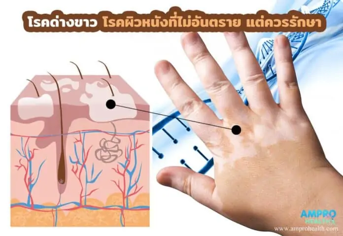 โรคด่างขาว โรคผิวหนังที่ไม่อันตราย แต่ควรรักษา