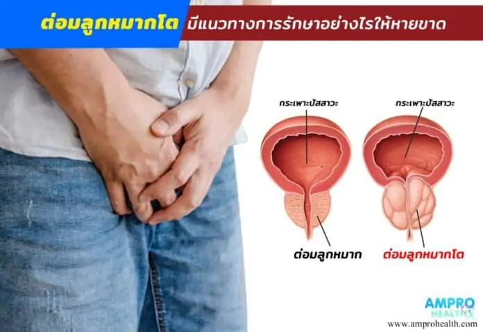 ต่อมลูกหมากโต มีแนวทางการรักษาอย่างไรให้หายขาด