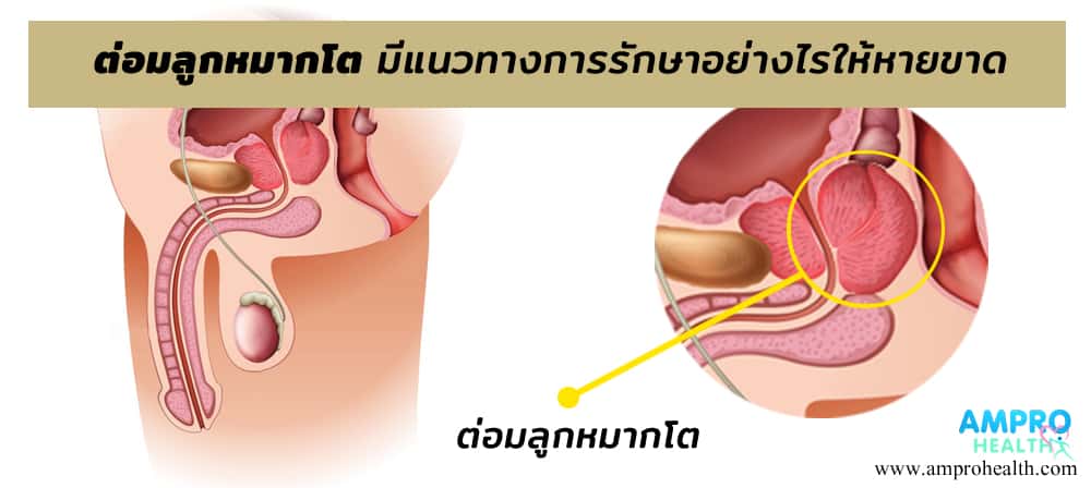 ต่อมลูกหมากโต มีแนวทางการรักษาอย่างไรให้หายขาด