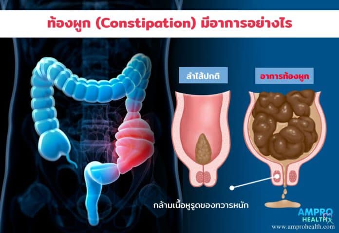 วิธีแก้ท้องผูกง่าย ๆ บทความนี้ช่วยคุณได้