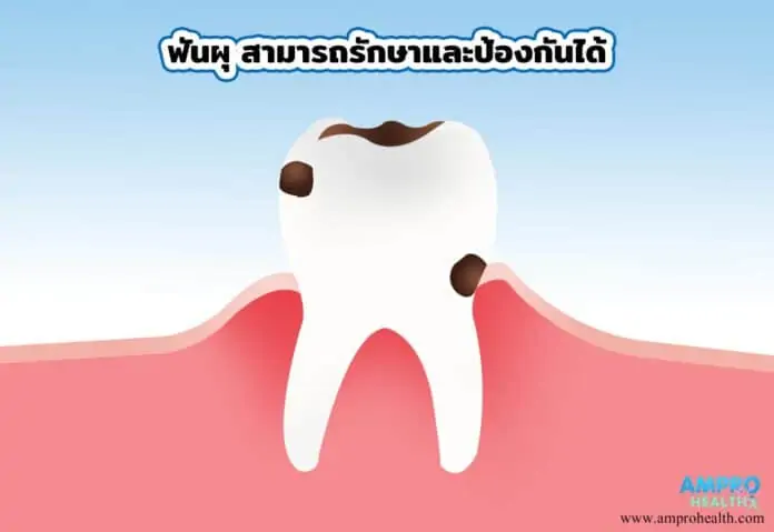 ฟันผุ สามารถรักษาและป้องกันได้ 