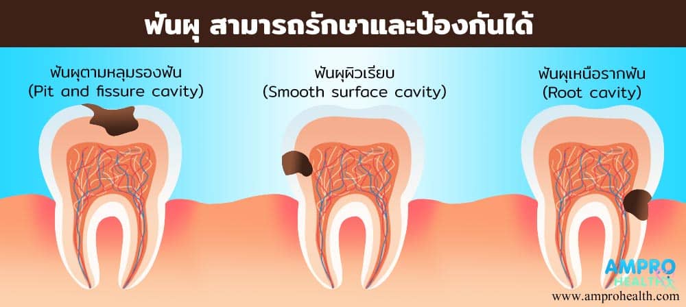 ฟันผุ สามารถรักษาและป้องกันได้ 