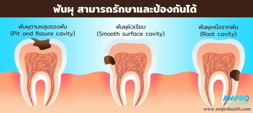ฟันผุ สามารถรักษาและป้องกันได้ 