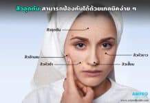 สิวอุดตัน สามารถป้องกันได้ด้วยเทคนิคง่าย ๆ สิวอุดตัน สามารถป้องกันได้ด้วยเทคนิคง่าย ๆ