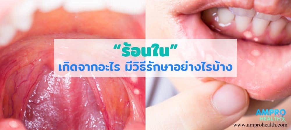 ร้อนในเกิดจากอะไร มีวิธีรักษาอย่างไรบ้าง