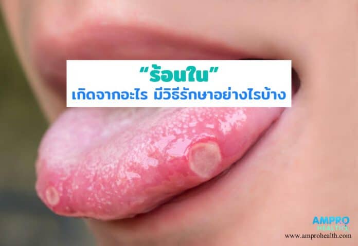 ร้อนในเกิดจากอะไร มีวิธีรักษาอย่างไรบ้าง