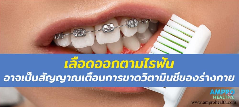 โรคเลือดออกตามไรฟัน หรือ โรคลักปิดลักเปิด