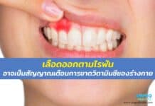 เลือดออกตามไรฟัน อาจเป็นสัญญาณเตือนการขาดวิตามินซีของร่างกาย โรคเลือดออกตามไรฟัน หรือ โรคลักปิดลักเปิด