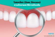 โรคเหงือก การรักษาและวิธีการป้องกัน โรคเหงือก การรักษาและวิธีการป้องกัน