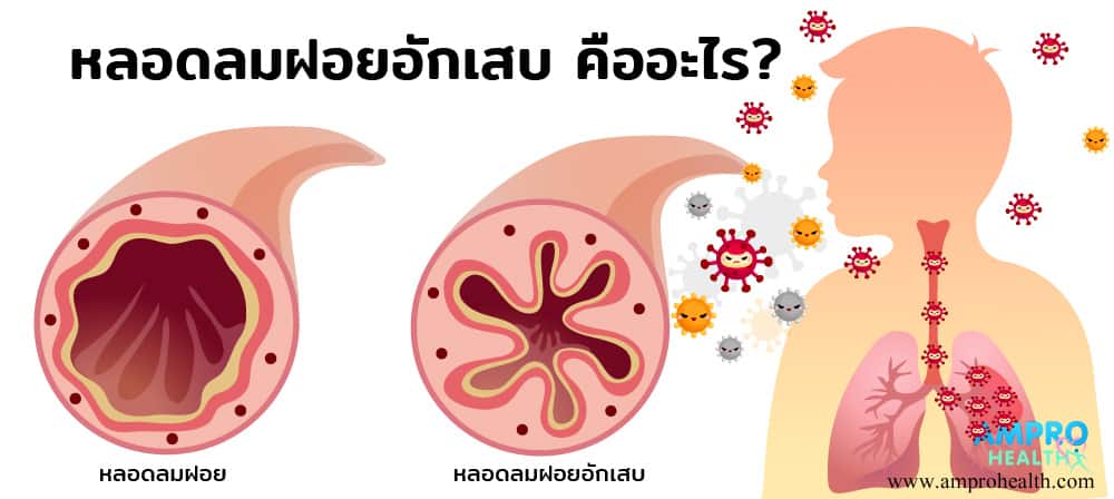 หลอดลมฝอยอักเสบ คืออะไร