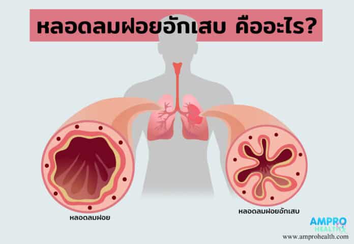 หลอดลมฝอยอักเสบ คืออะไร