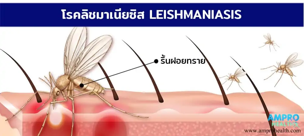 โรคลิชมาเนีย ( Leishmaniasis )