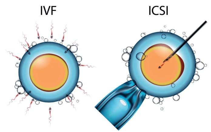 ทำเด็กหลอดแก้ว - ความรู้เบื้องต้นของเด็กหลอดแก้ว ICSI คำตอบของผู้มีบุตรยาก ! ทำเด็กหลอดแก้ว