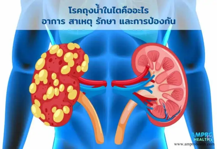 โรคถุงน้ำในไตคืออะไรอาการสาเหตุรักษาและการป้องกัน