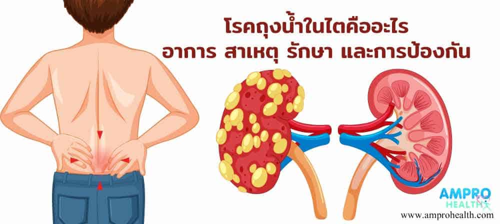 โรคถุงน้ำในไตคืออะไรอาการสาเหตุรักษาและการป้องกัน โรคถุงน้ำในไตคืออะไรอาการสาเหตุรักษาและการป้องกัน