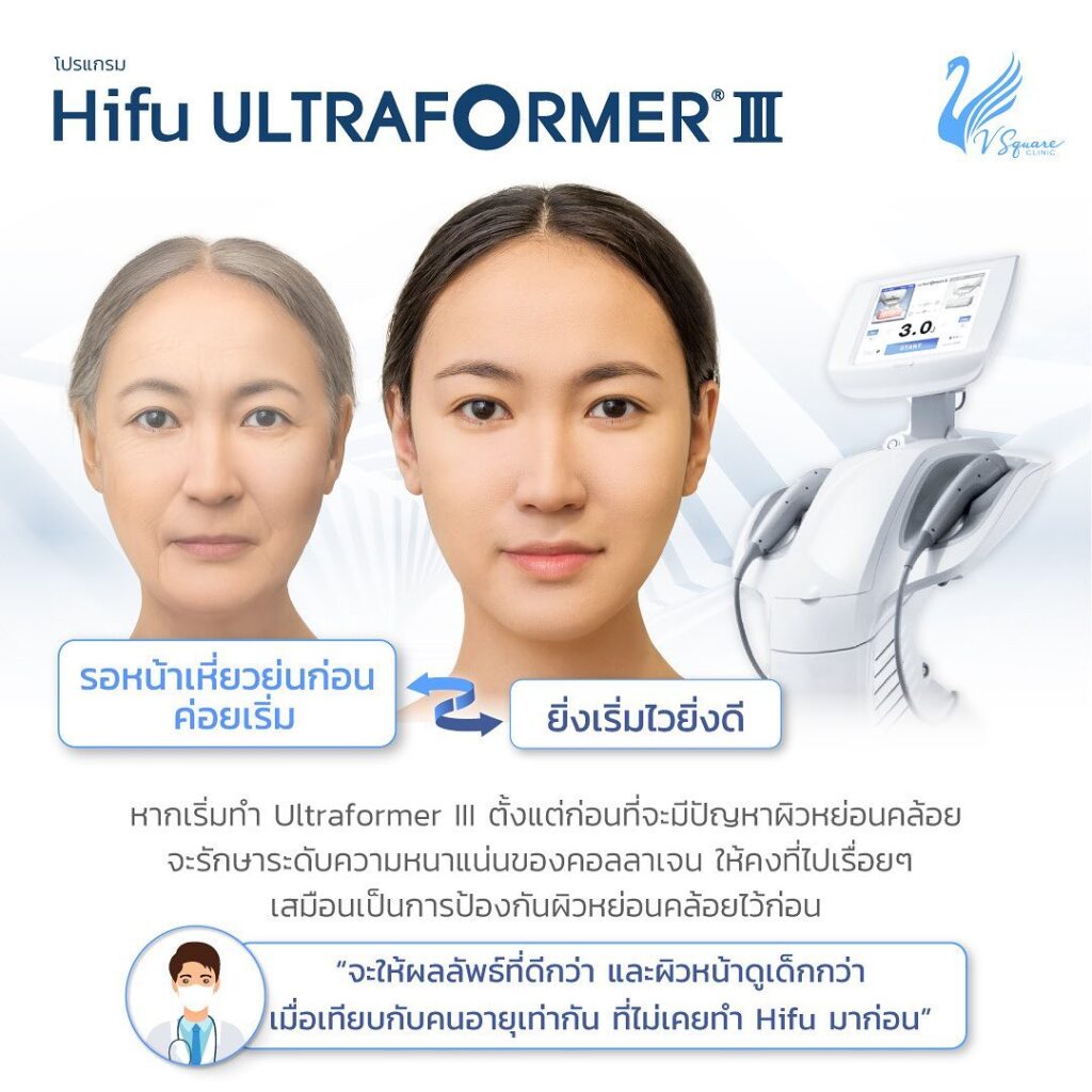 ทำ Ultraformer III