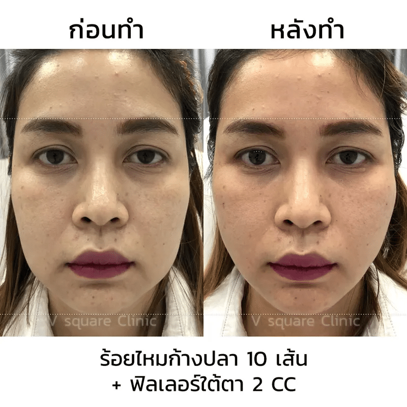 รีวิว ร้อยไหมยกกระชับหน้า