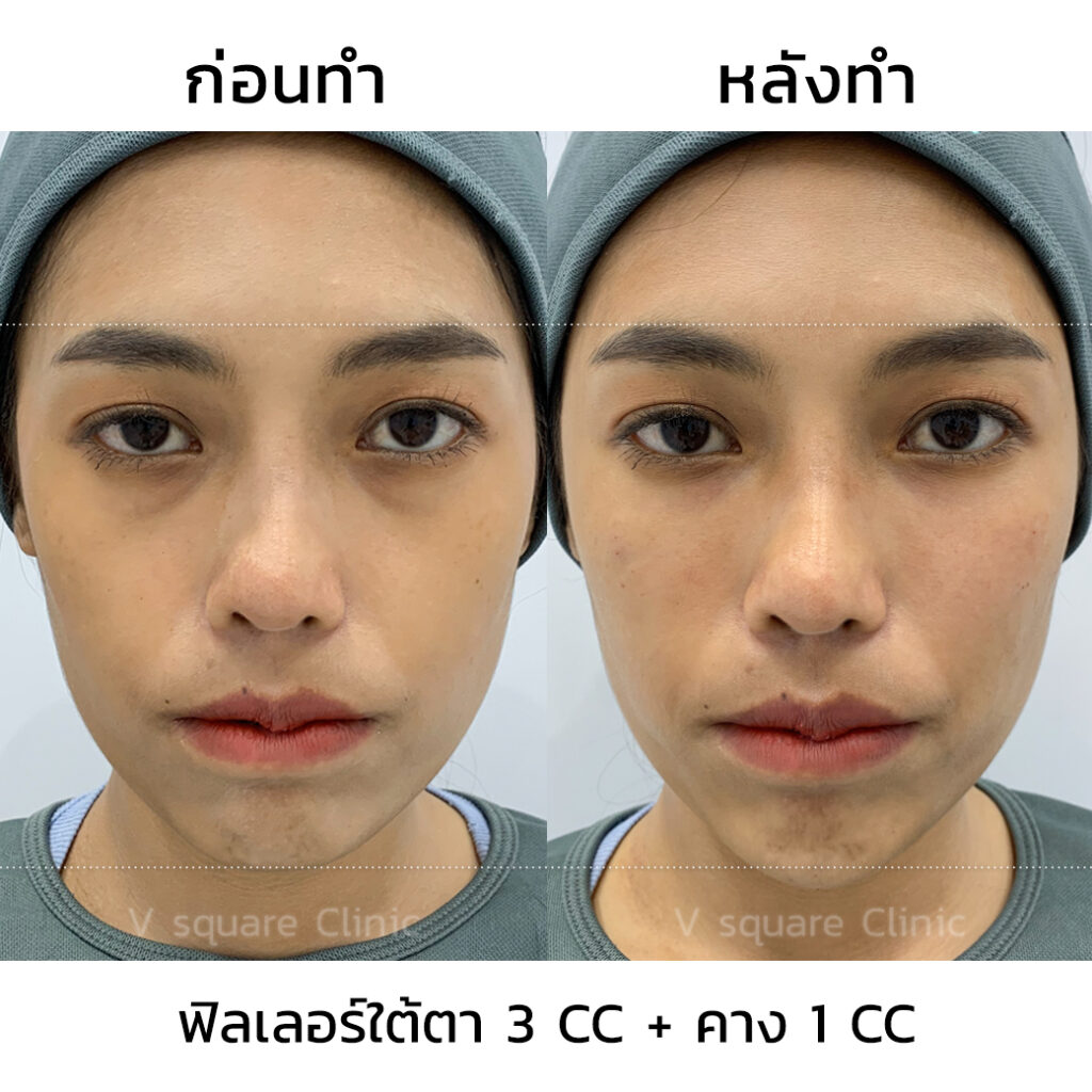 รีวิวฉีดฟิลเลอร์คาง 1 CC ที่ V Square Clinic - รวมข้อควรรู้ก่อน ฉีดฟิลเลอร์คาง ดีอย่างไร ? มีผลข้างเคียงไหม ?