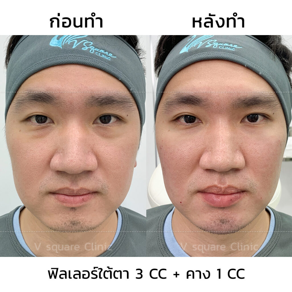 รีวิวฉีดฟิลเลอร์คาง 1 CC ที่ V Square Clinic 