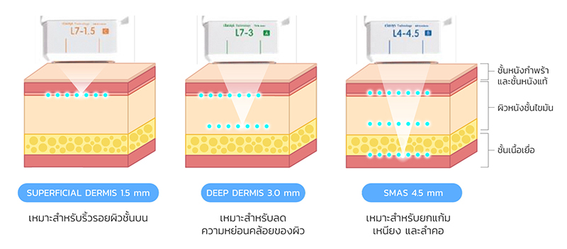 หัวยิง Ulthera SPT